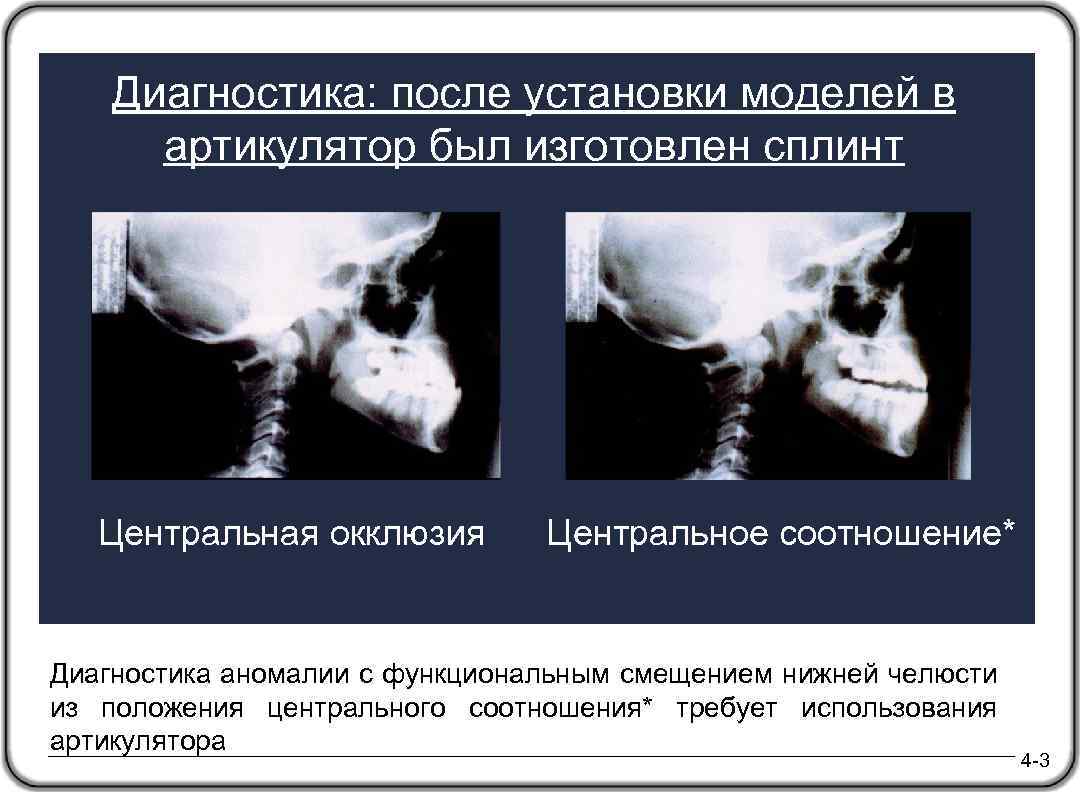 Диагностика: после установки моделей в артикулятор был изготовлен сплинт Центральная окклюзия Центральное соотношение* Диагностика