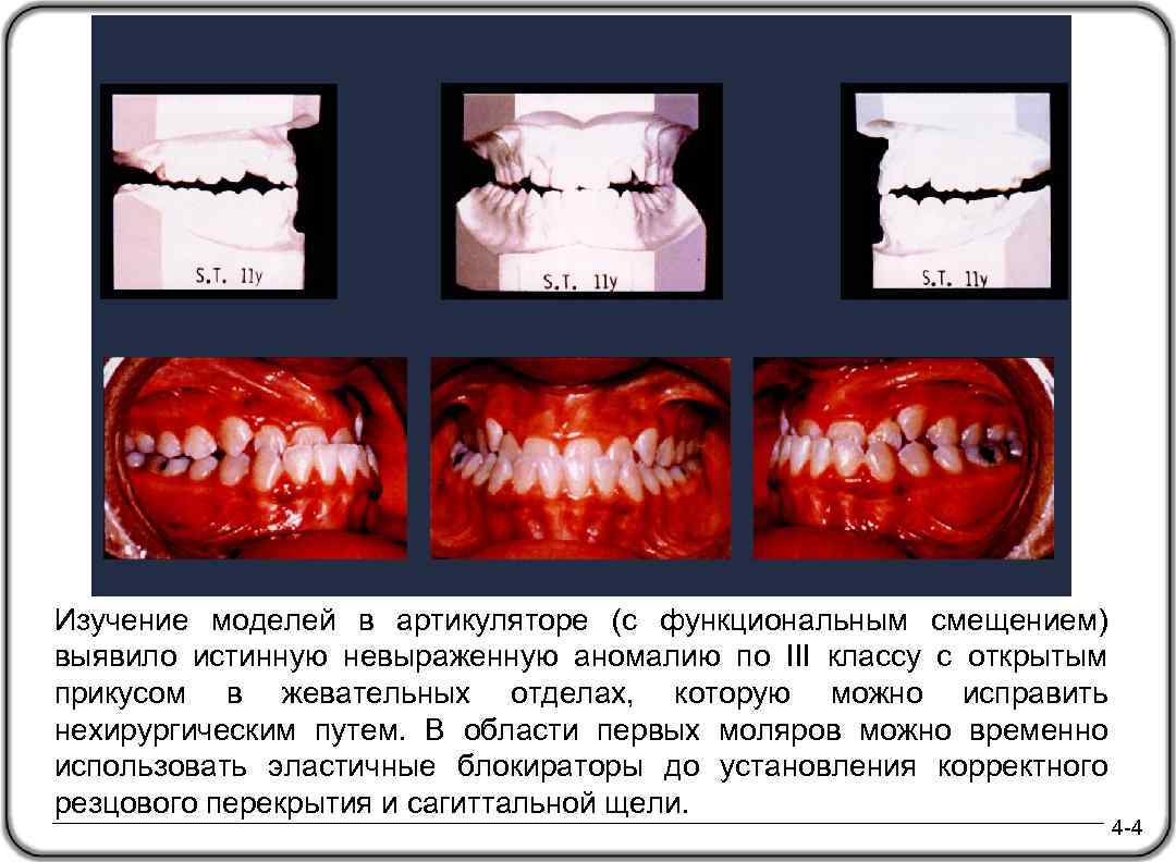 Изучение моделей в артикуляторе (с функциональным смещением) выявило истинную невыраженную аномалию по III классу