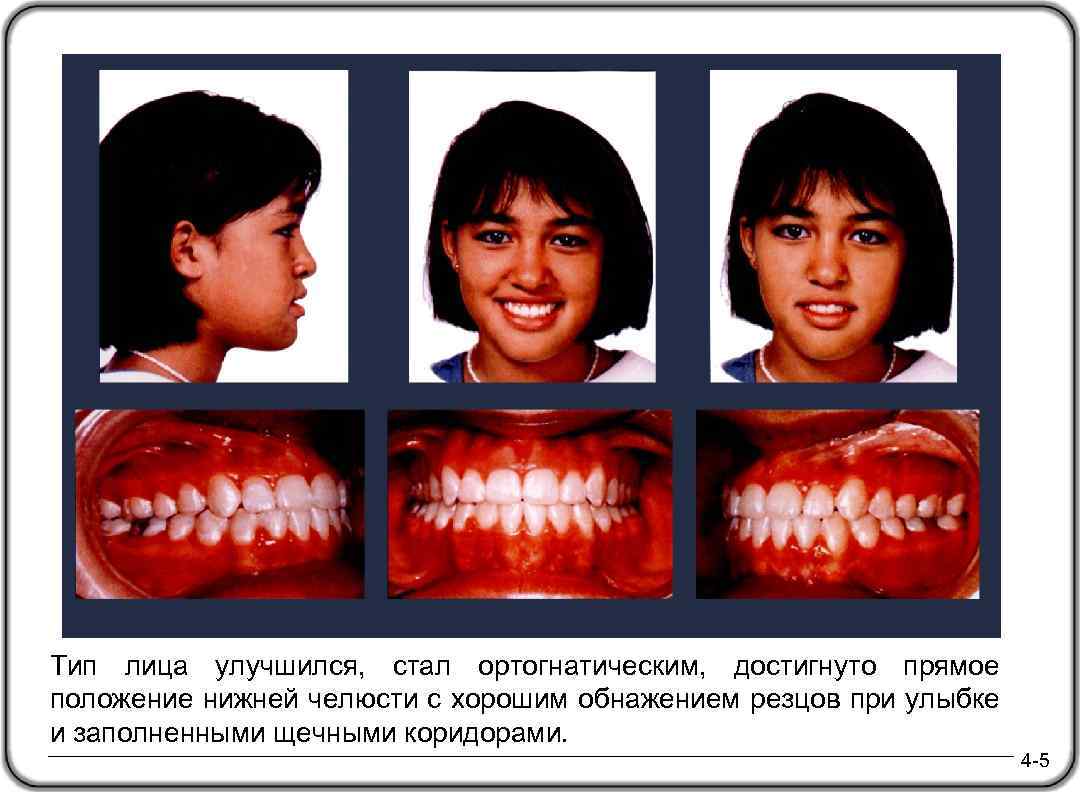 Тип лица улучшился, стал ортогнатическим, достигнуто прямое положение нижней челюсти с хорошим обнажением резцов