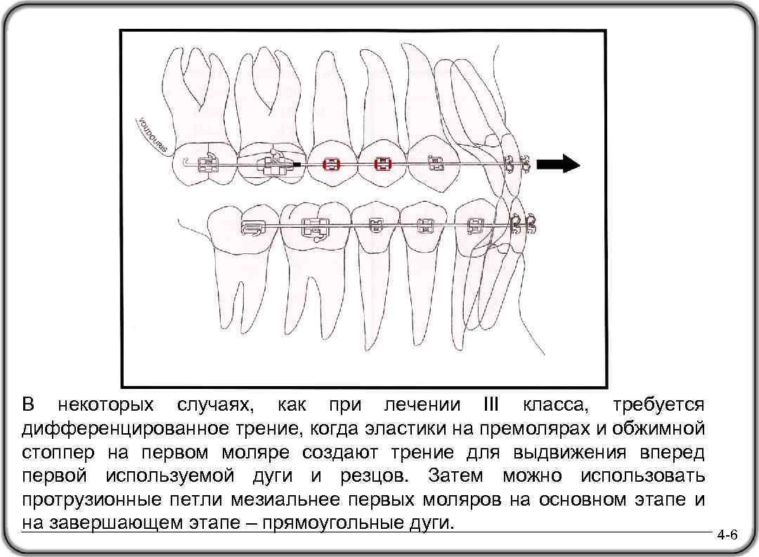 В некоторых случаях, как при лечении III класса, требуется дифференцированное трение, когда эластики на