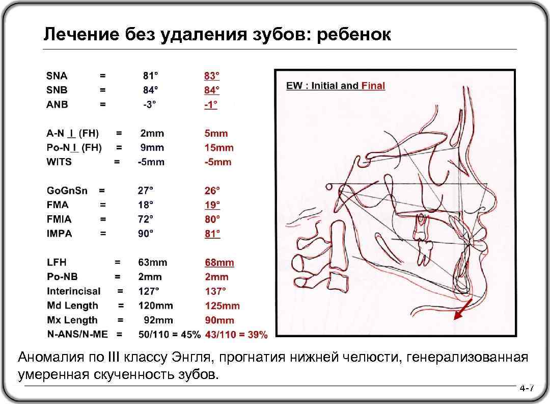 Лечение без удаления зубов: ребенок Аномалия по III классу Энгля, прогнатия нижней челюсти, генерализованная