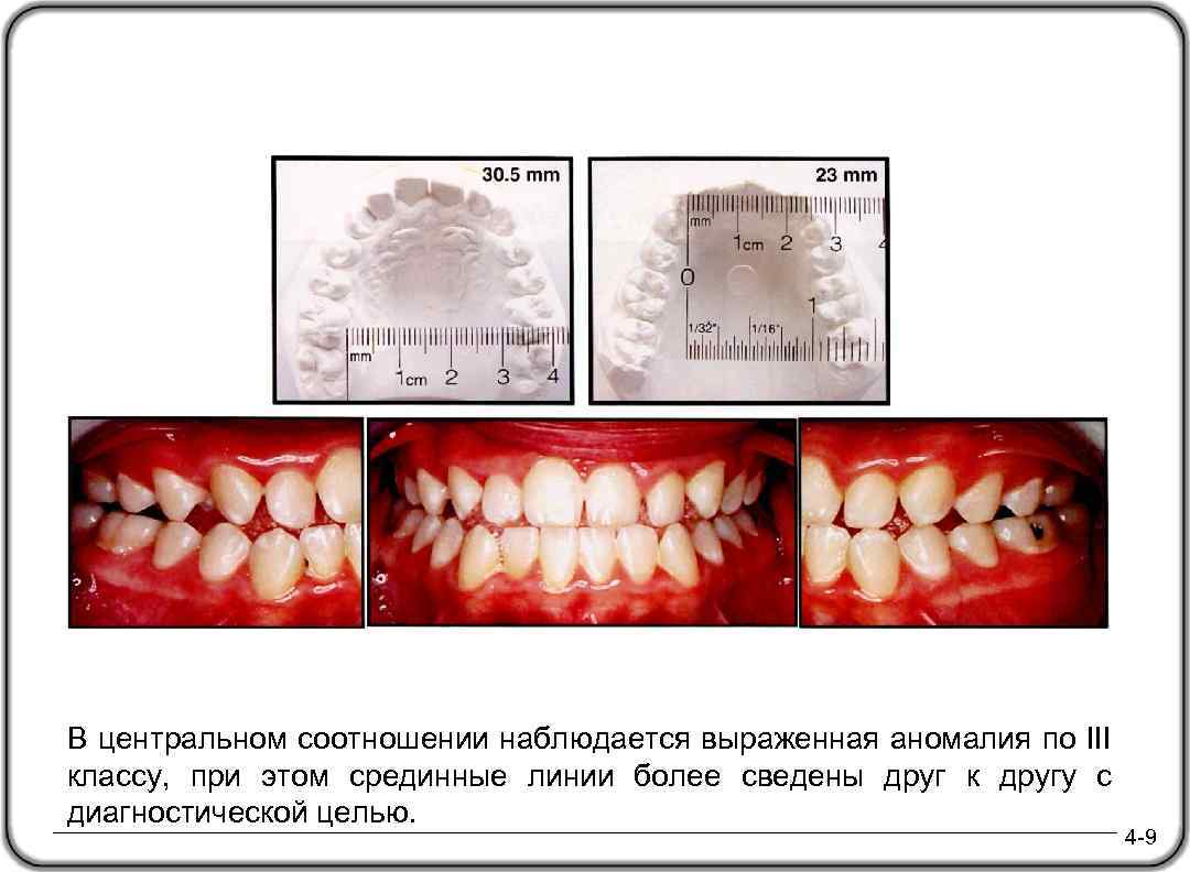 В центральном соотношении наблюдается выраженная аномалия по III классу, при этом срединные линии более