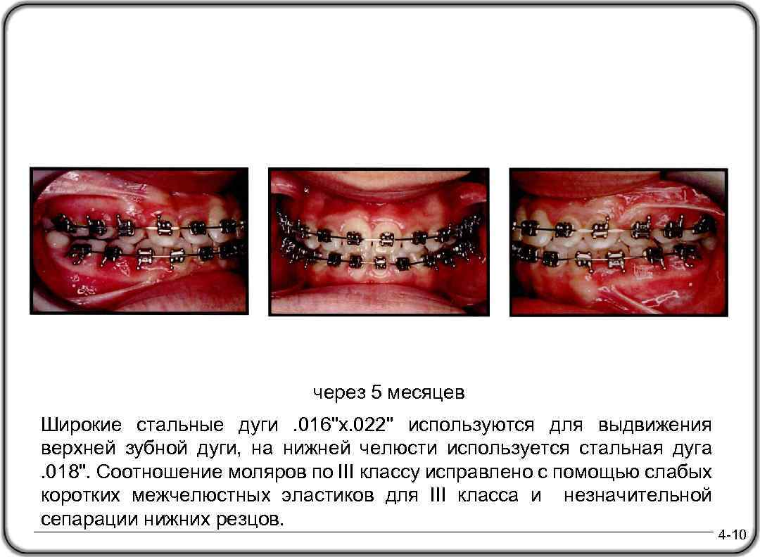через 5 месяцев Широкие стальные дуги . 016"x. 022" используются для выдвижения верхней зубной