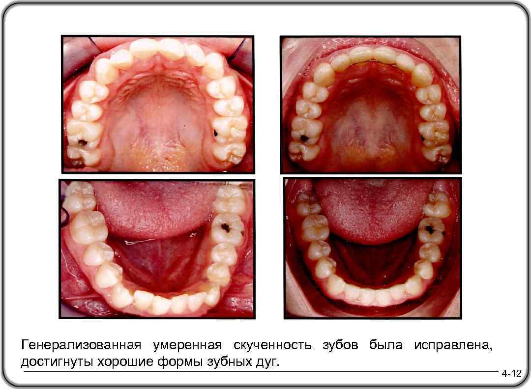 Генерализованная умеренная скученность зубов была исправлена, достигнуты хорошие формы зубных дуг. 4 -12 