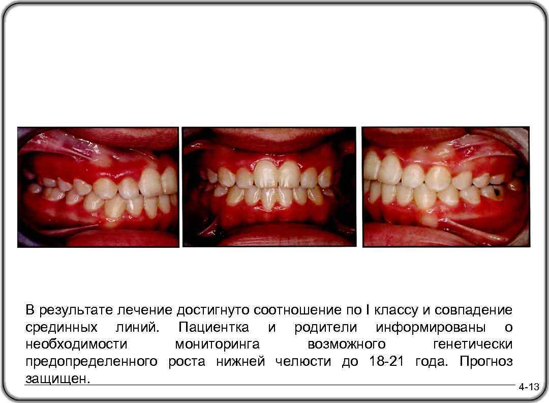В результате лечение достигнуто соотношение по I классу и совпадение срединных линий. Пациентка и