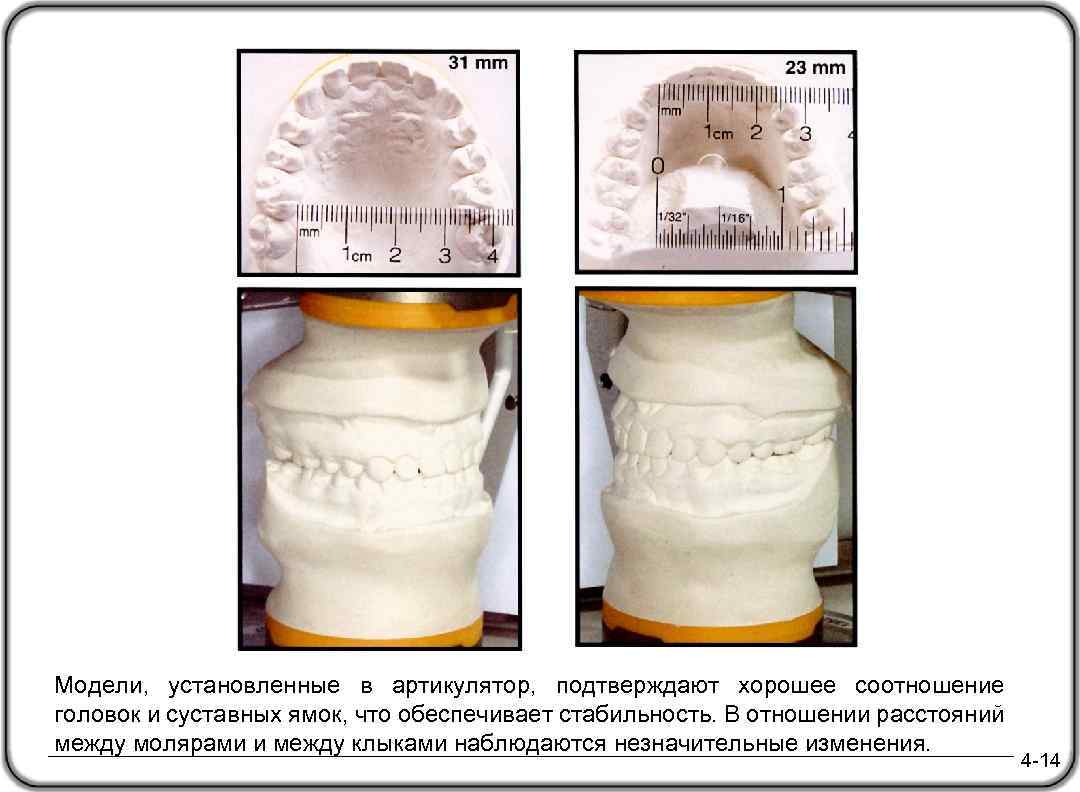 Модели, установленные в артикулятор, подтверждают хорошее соотношение головок и суставных ямок, что обеспечивает стабильность.