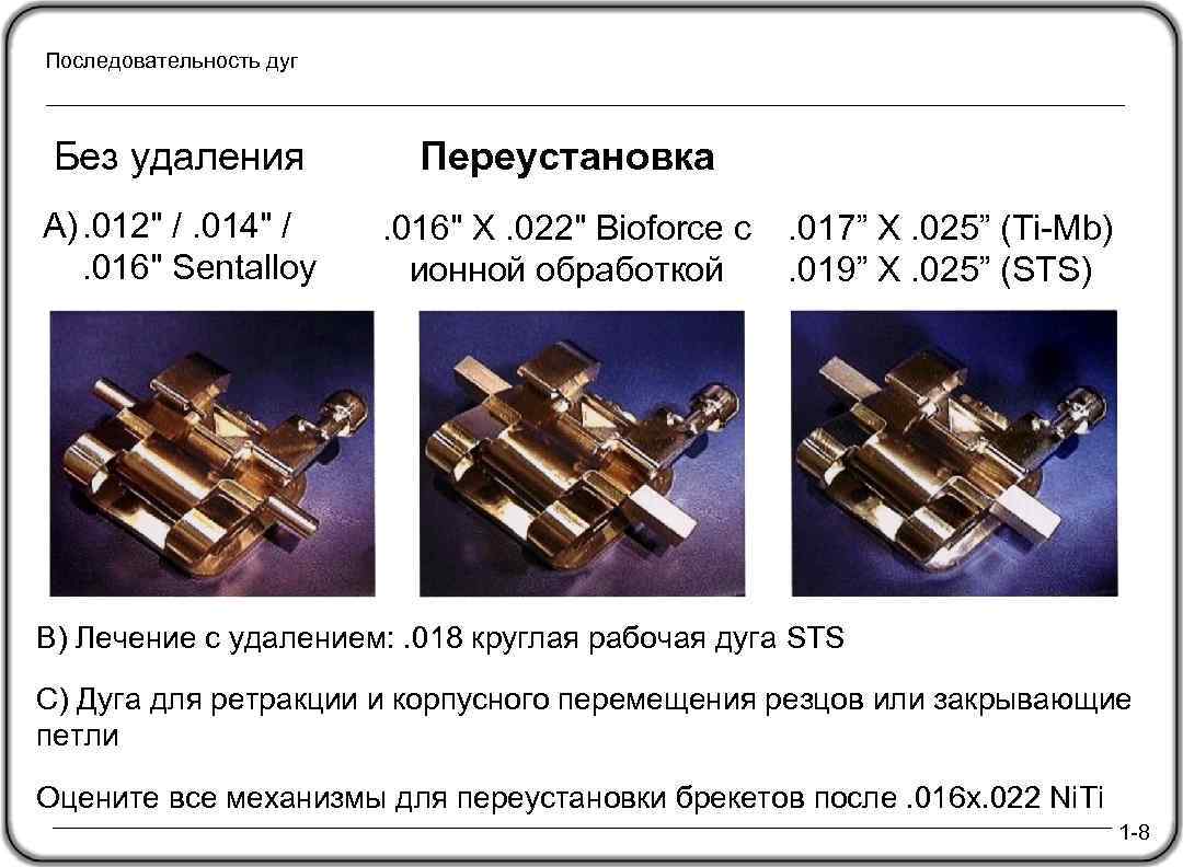 Последовательность дуг Без удаления A). 012" /. 014" / . 016" Sentalloy Переустановка. 016"