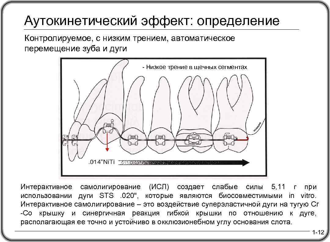 Аутокинетический эффект: определение Контролируемое, с низким трением, автоматическое перемещение зуба и дуги - Низкое