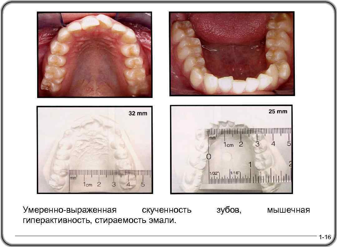 Умеренно-выраженная скученность гиперактивность, стираемость эмали. зубов, мышечная 1 -16 