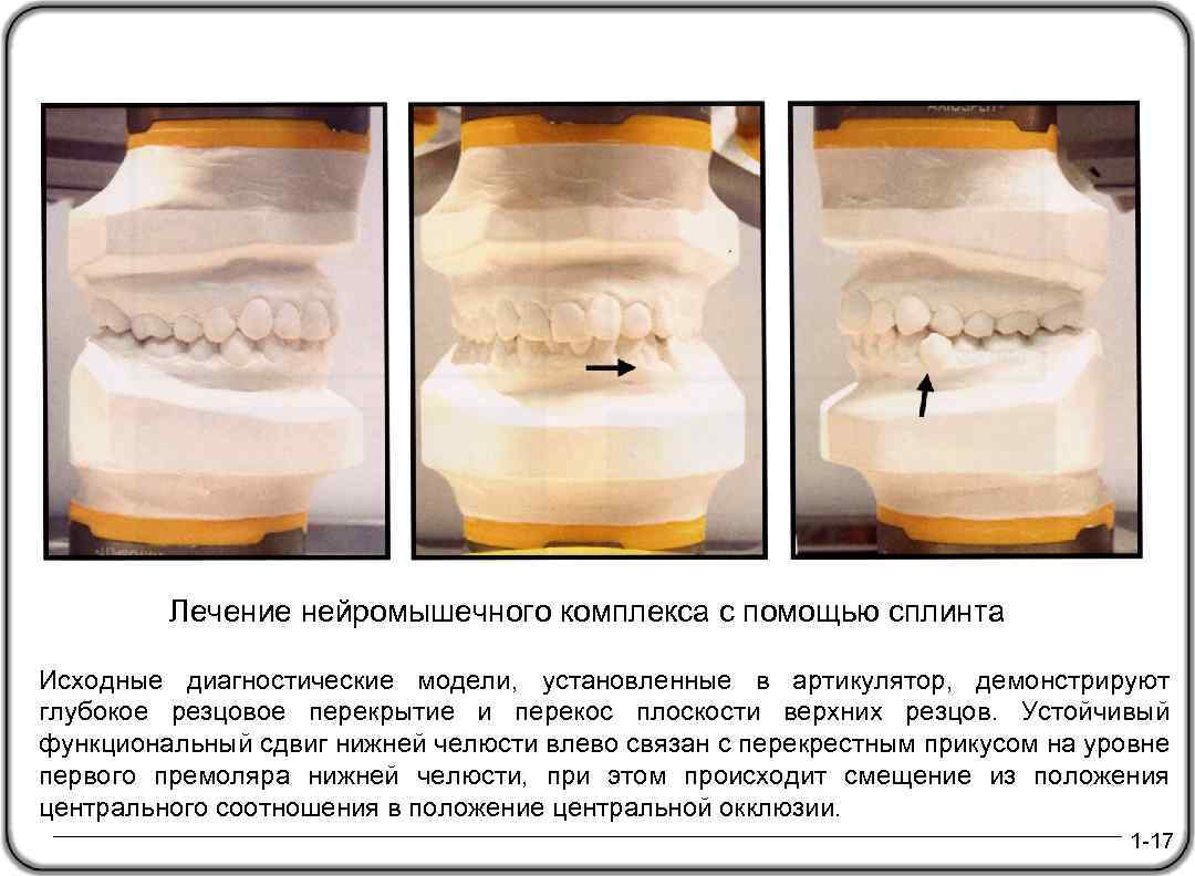 Лечение нейромышечного комплекса с помощью сплинта Исходные диагностические модели, установленные в артикулятор, демонстрируют глубокое