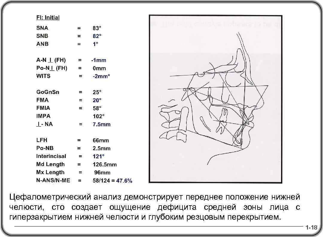 Цефалометрический анализ демонстрирует переднее положение нижней челюсти, сто создает ощущение дефицита средней зоны лица