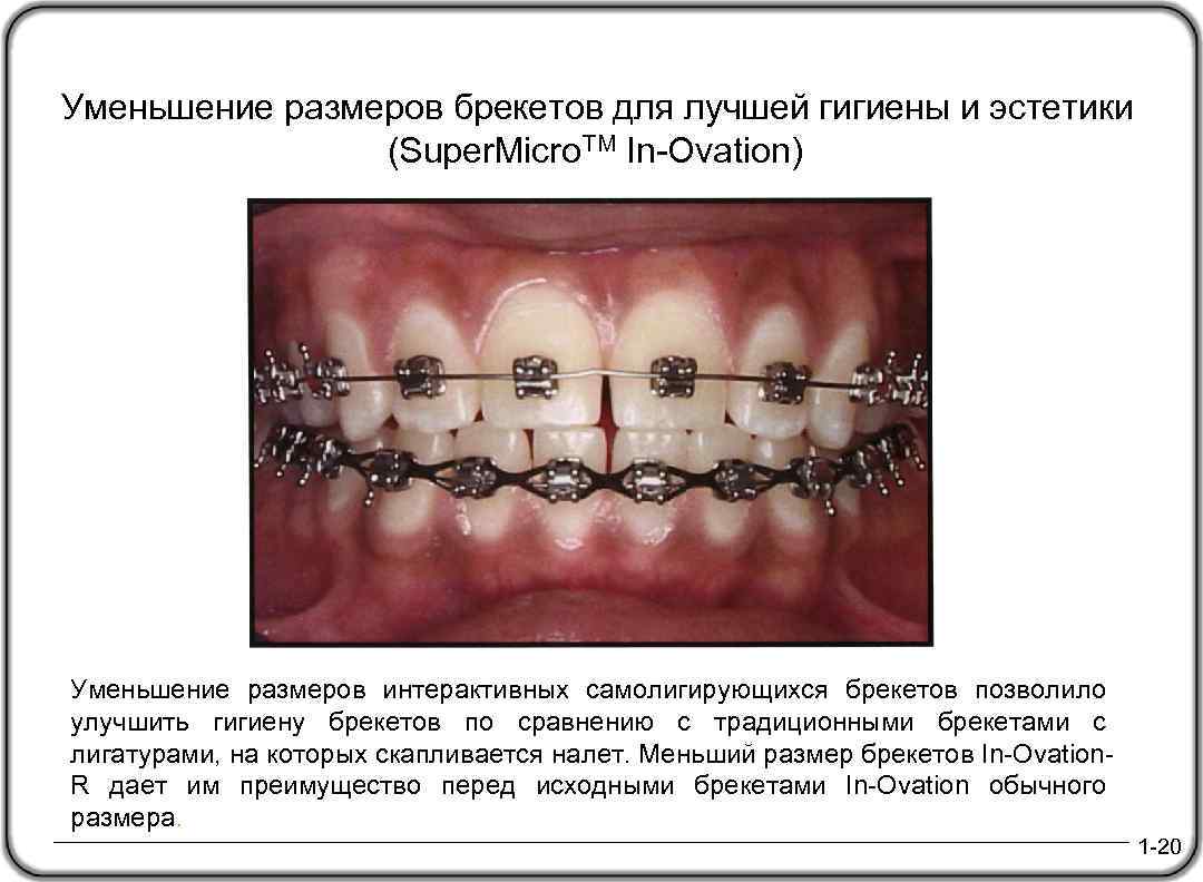 Уменьшение размеров брекетов для лучшей гигиены и эстетики (Super. Micro. TM In-Ovation) Уменьшение размеров