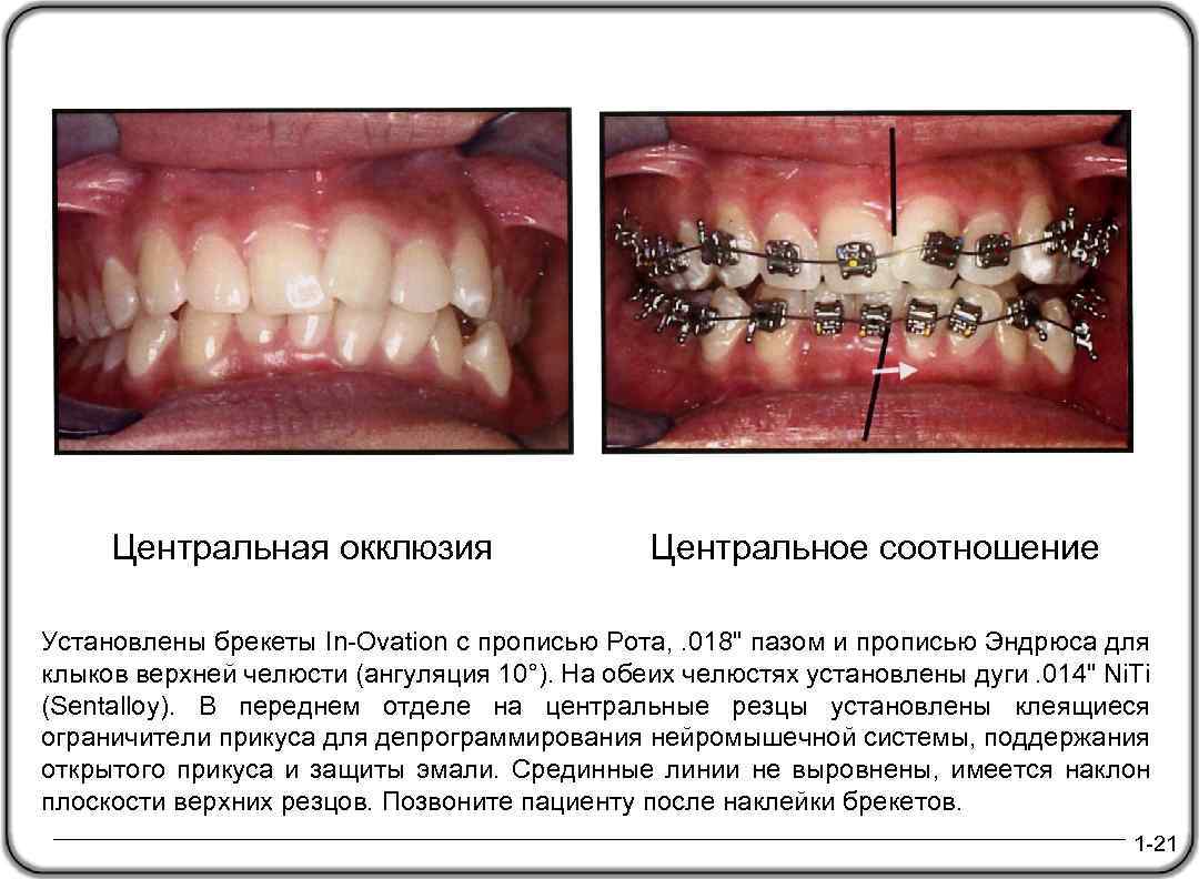  Центральная окклюзия Центральное соотношение Установлены брекеты In-Ovation с прописью Рота, . 018" пазом