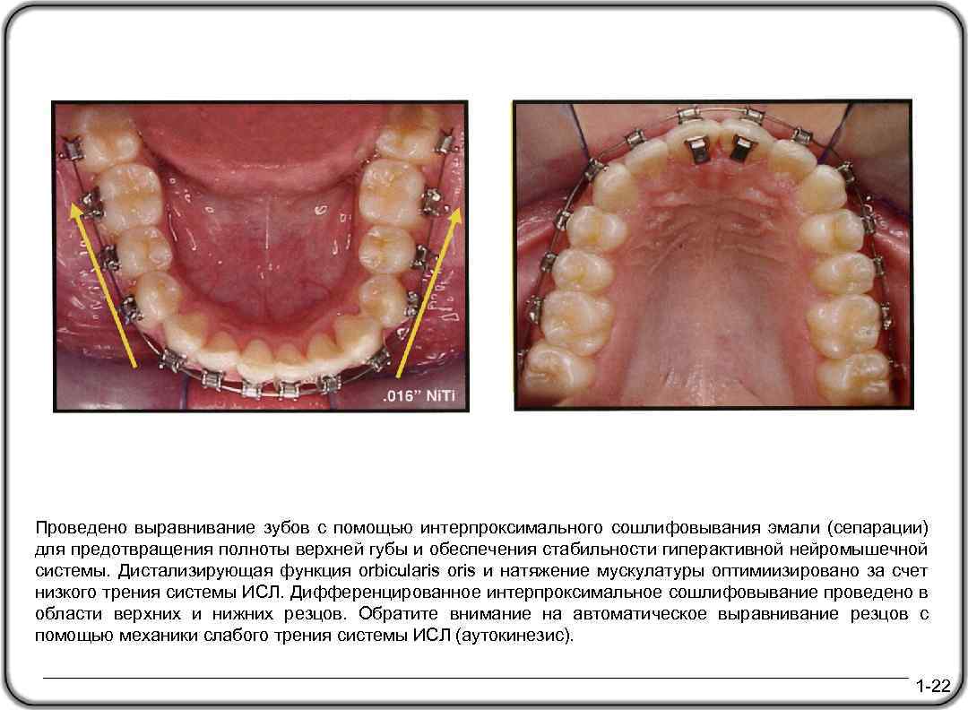 Проведено выравнивание зубов с помощью интерпроксимального сошлифовывания эмали (сепарации) для предотвращения полноты верхней губы