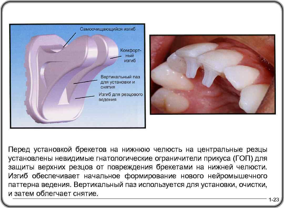 Перед установкой брекетов на нижнюю челюсть на центральные резцы установлены невидимые гнатологические ограничители прикуса