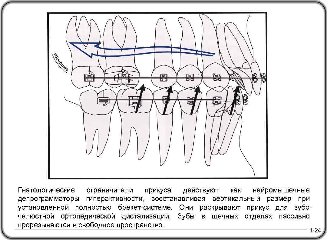 Гнатологические ограничители прикуса действуют как нейромышечные депрограмматоры гиперактивности, восстанавливая вертикальный размер при установленной полностью