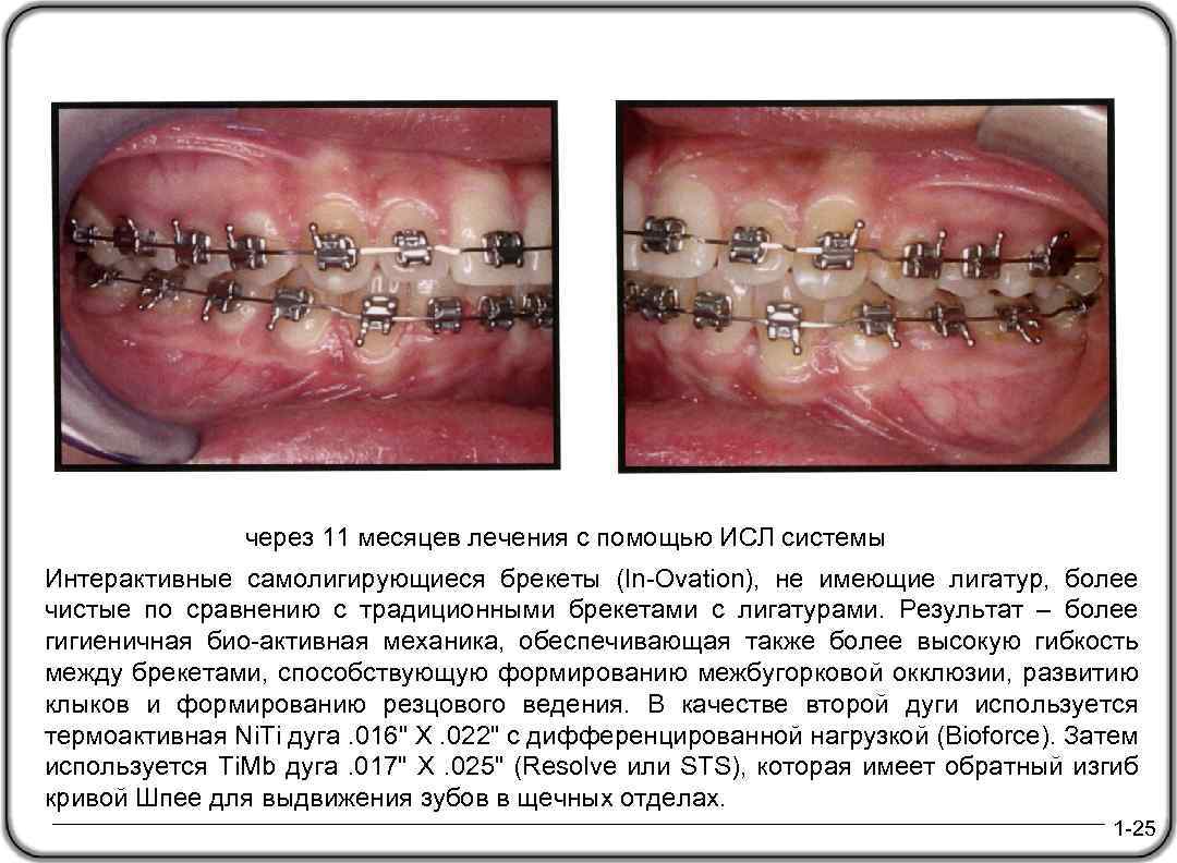через 11 месяцев лечения с помощью ИСЛ системы Интерактивные самолигирующиеся брекеты (In-Ovation), не имеющие