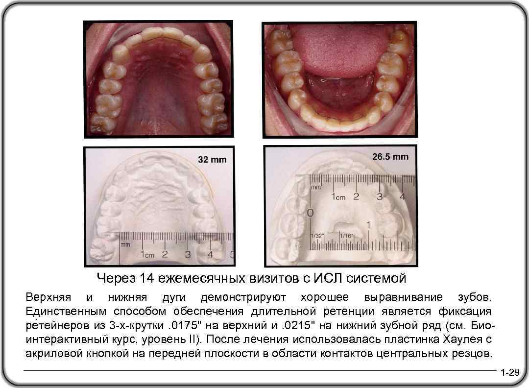 Через 14 ежемесячных визитов с ИСЛ системой Верхняя и нижняя дуги демонстрируют хорошее выравнивание