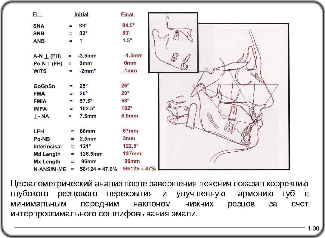 Цефалометрический анализ после завершения лечения показал коррекцию глубокого резцового перекрытия и улучшенную гармонию губ