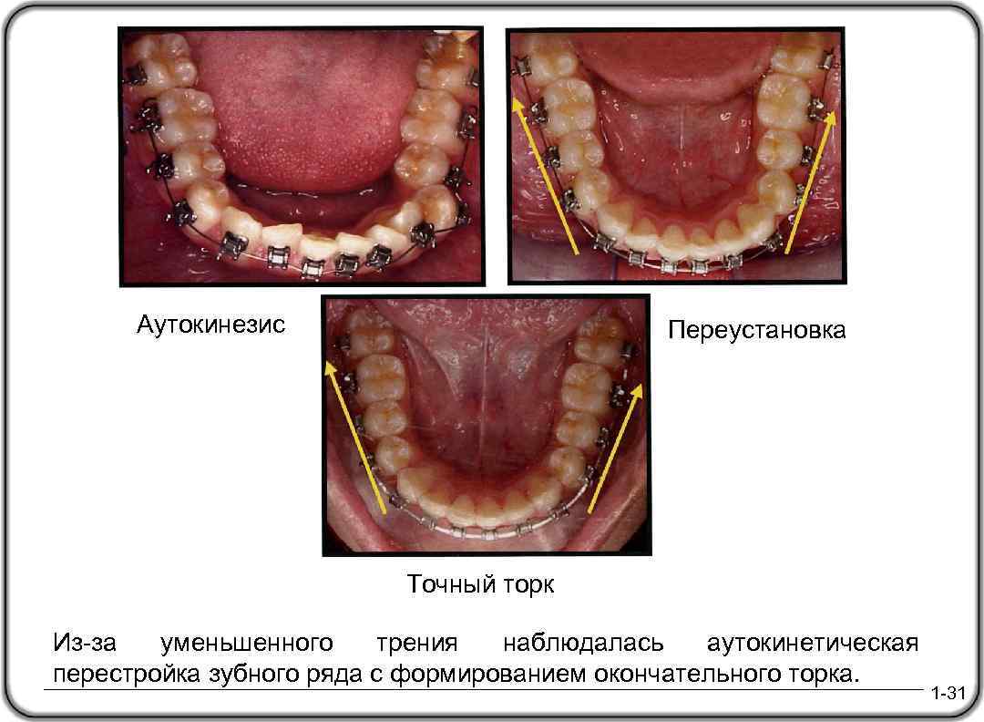 Аутокинезис Переустановка Точный торк Из-за уменьшенного трения наблюдалась аутокинетическая перестройка зубного ряда с формированием