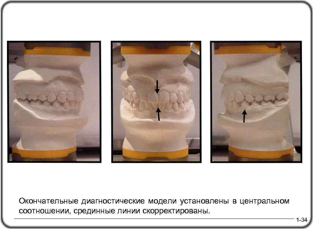 Окончательные диагностические модели установлены в центральном соотношении, срединные линии скорректированы. 1 -34 