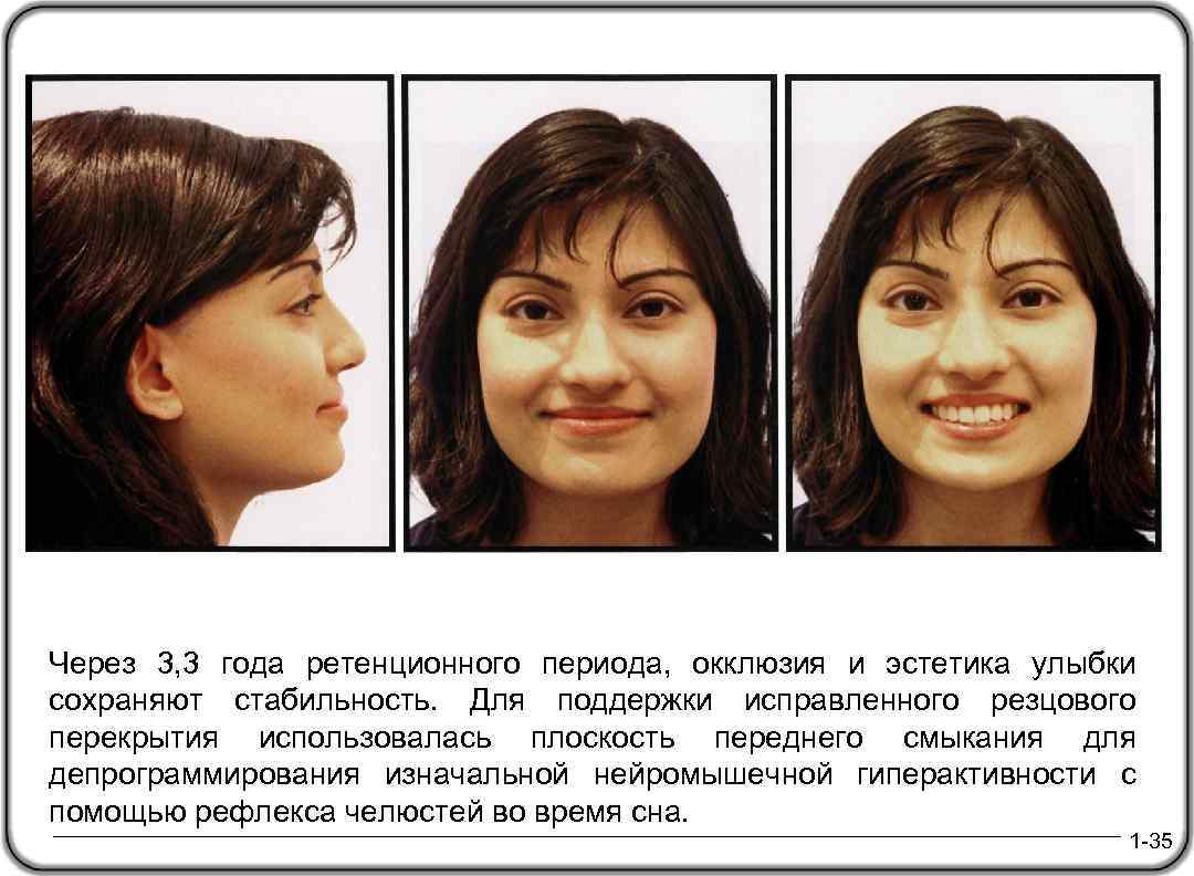 Через 3, 3 года ретенционного периода, окклюзия и эстетика улыбки сохраняют стабильность. Для поддержки