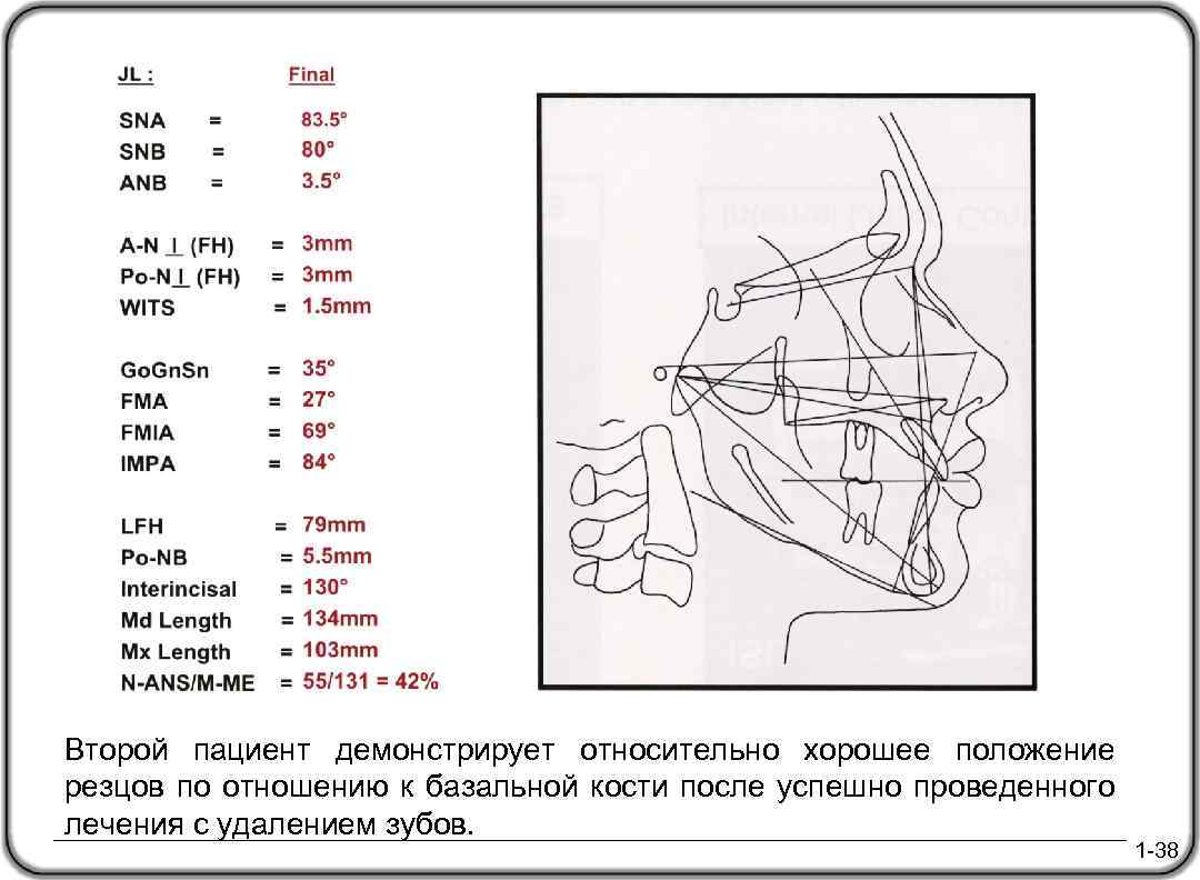 Второй пациент демонстрирует относительно хорошее положение резцов по отношению к базальной кости после успешно
