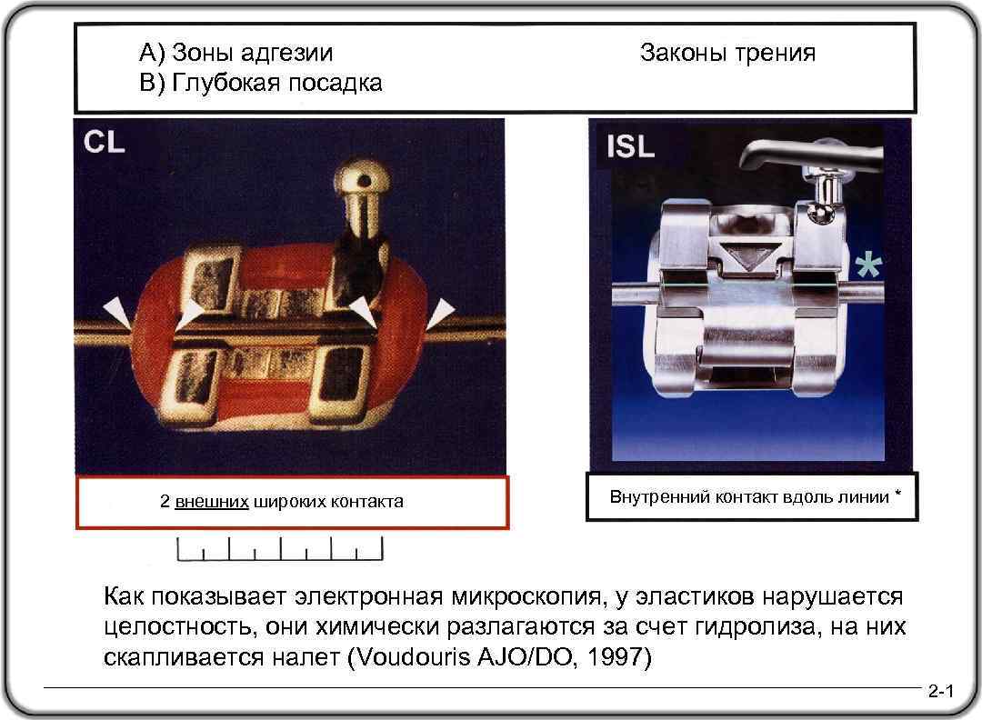 A) Зоны адгезии Законы трения B) Глубокая посадка 2 внешних широких контакта Внутренний контакт