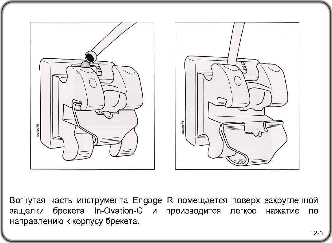 Вогнутая часть инструмента Engage R помещается поверх закругленной защелки брекета In-Ovation-C и производится легкое