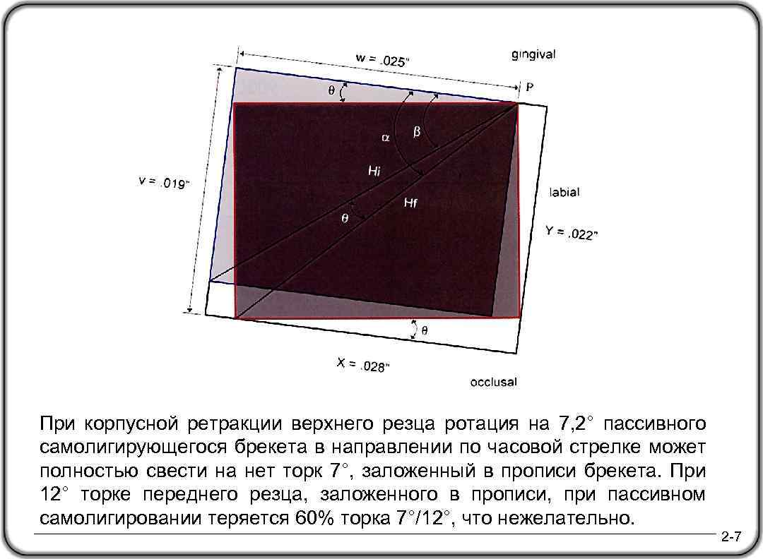 При корпусной ретракции верхнего резца ротация на 7, 2° пассивного самолигирующегося брекета в направлении