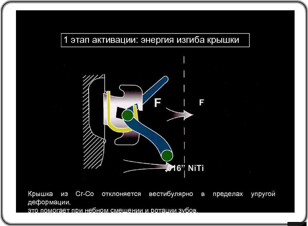 1 этап активации: энергия изгиба крышки Крышка из Cr-Co отклоняется вестибулярно в пределах упругой