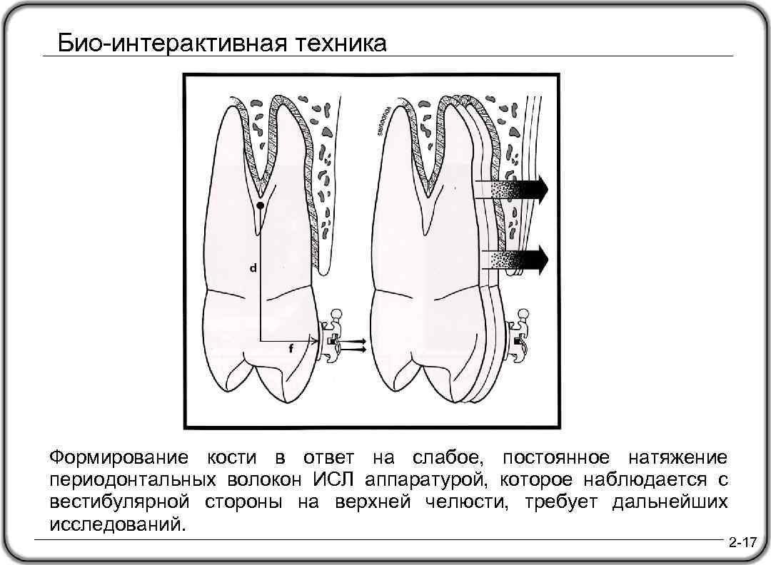 Био-интерактивная техника Формирование кости в ответ на слабое, постоянное натяжение периодонтальных волокон ИСЛ аппаратурой,