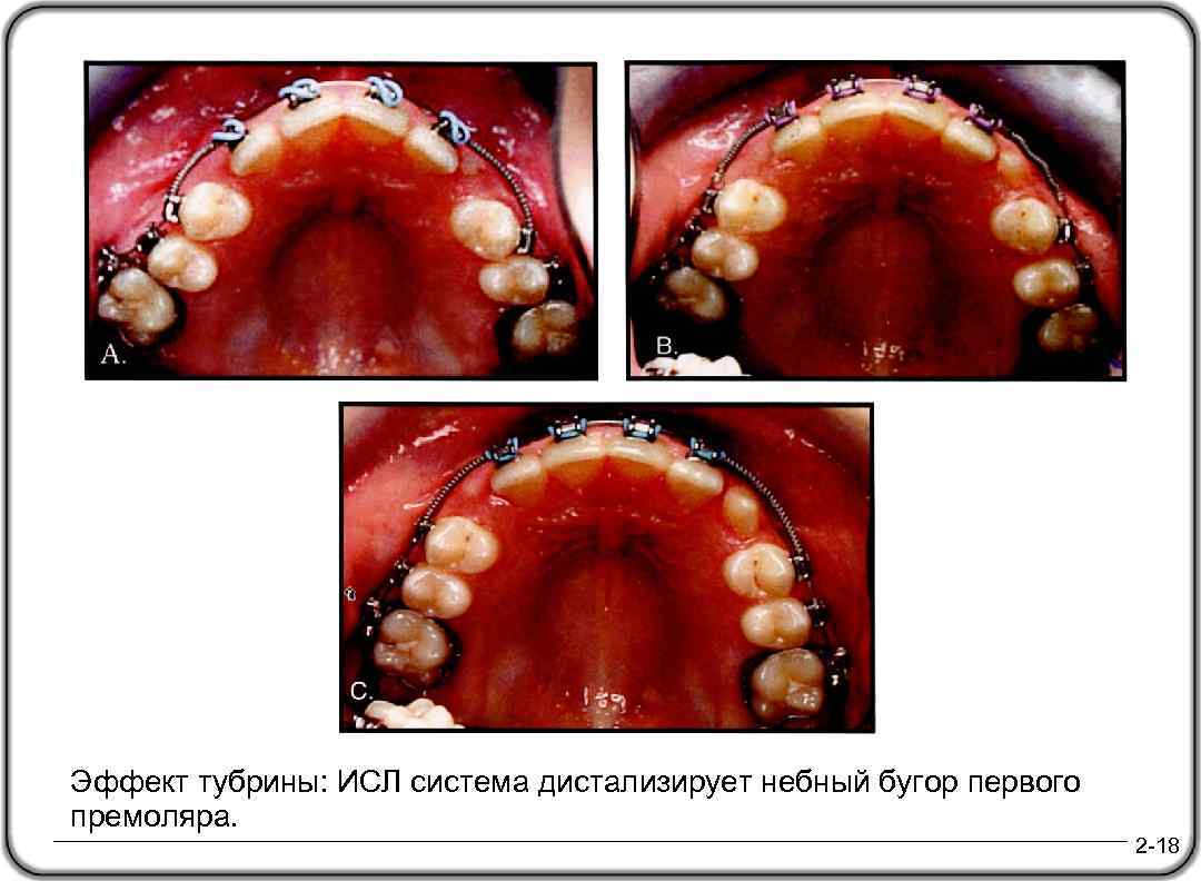 Эффект тубрины: ИСЛ система дистализирует небный бугор первого премоляра. 2 -18 