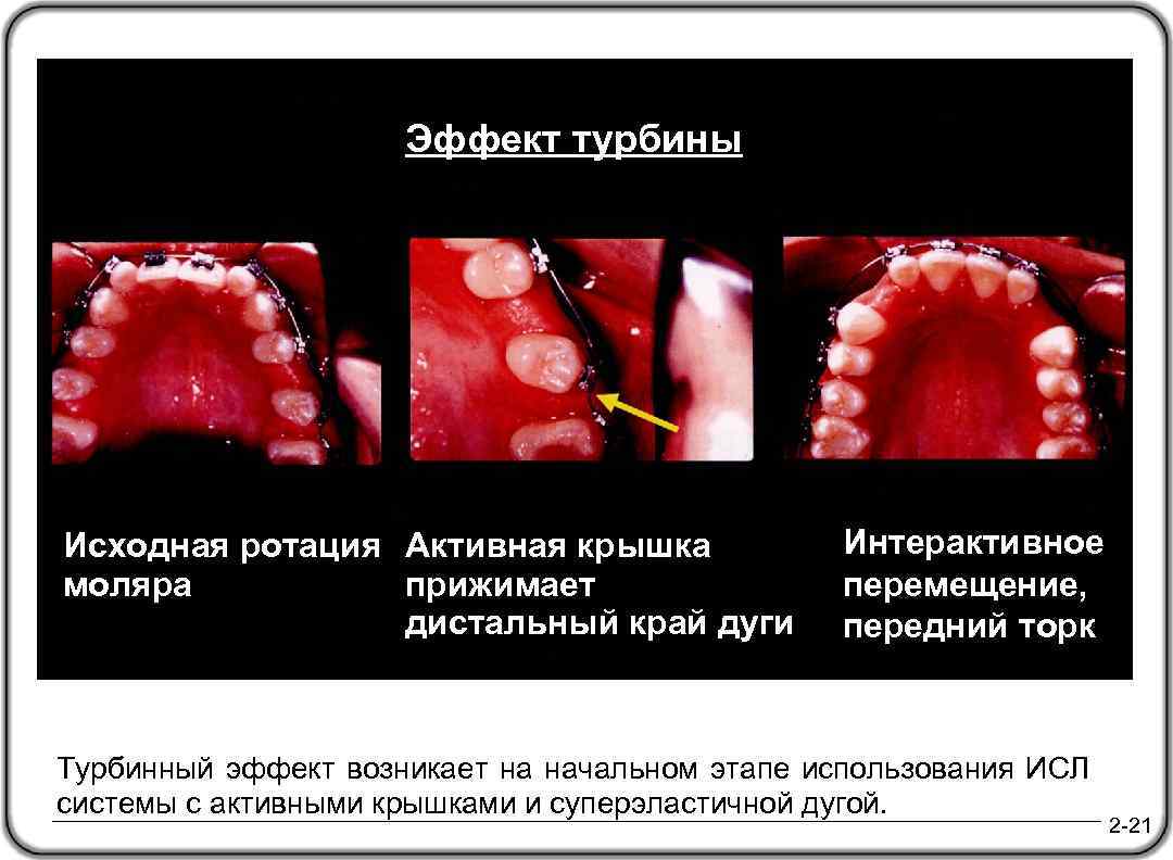 Эффект турбины Исходная ротация Активная крышка моляра прижимает дистальный край дуги Интерактивное перемещение, передний