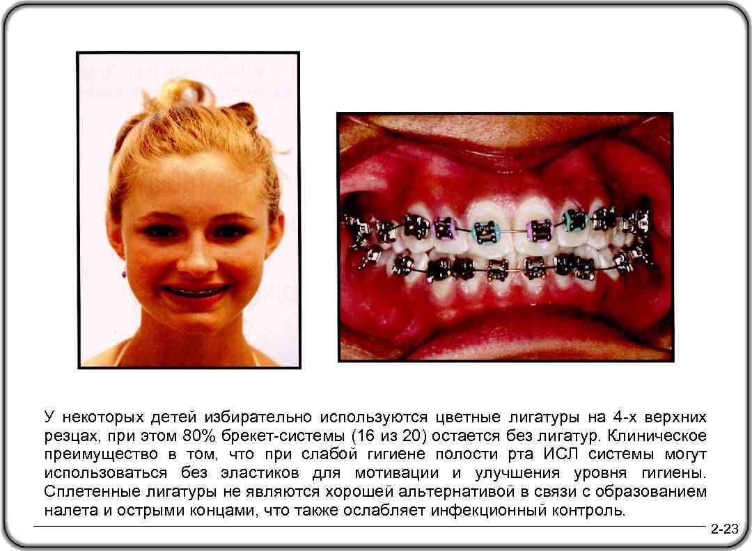 У некоторых детей избирательно используются цветные лигатуры на 4 -х верхних резцах, при этом