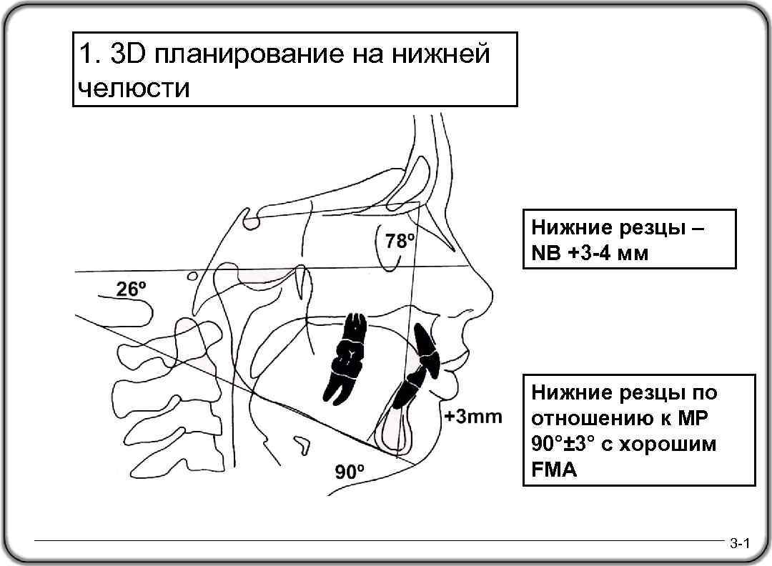 1. 3 D планирование на нижней челюсти Нижние резцы – NB +3 -4 мм