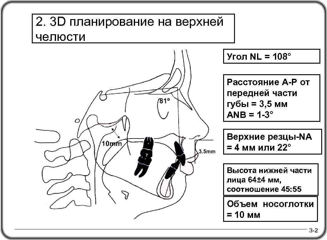 2. 3 D планирование на верхней челюсти Угол NL = 108° Расстояние A-P от