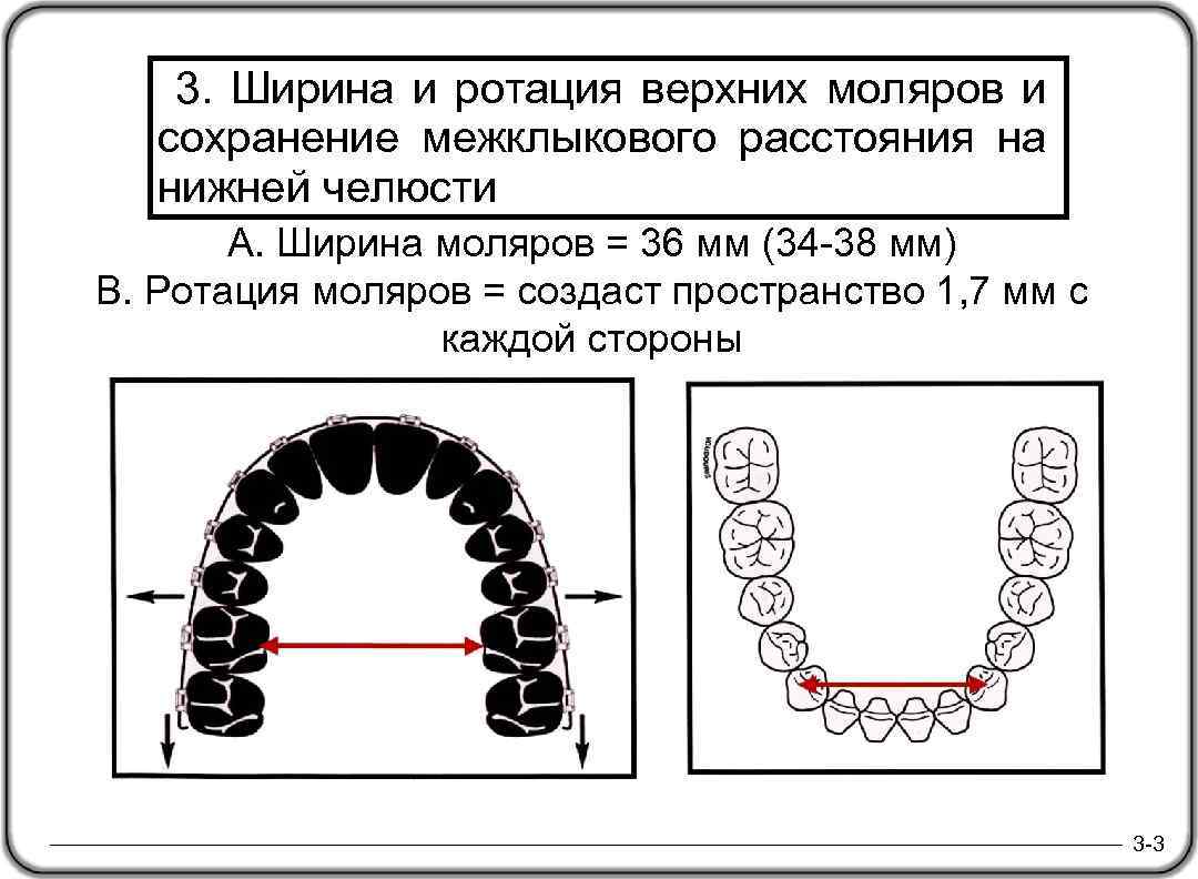  3. Ширина и ротация верхних моляров и сохранение межклыкового расстояния на нижней челюсти