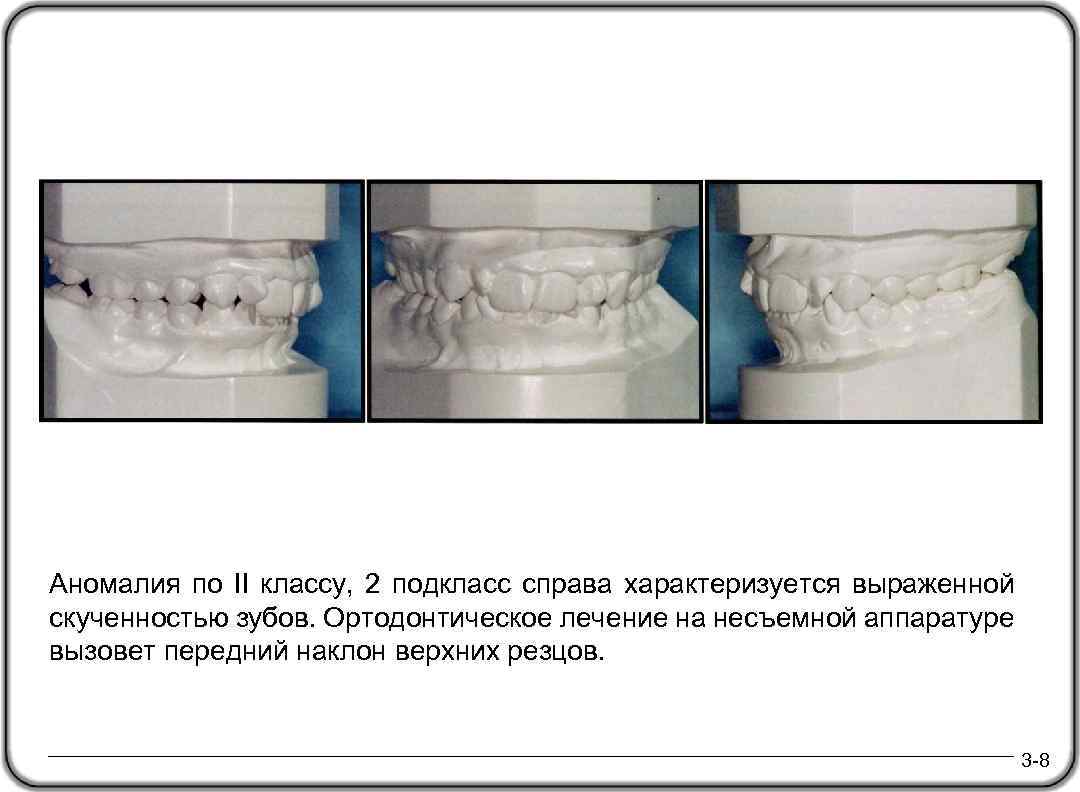 DL Аномалия по II классу, 2 подкласс справа характеризуется выраженной April 24, 2000 скученностью