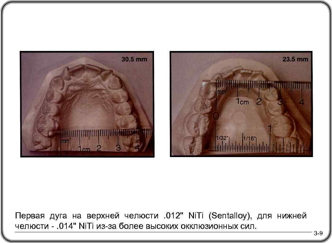 Первая дуга на верхней челюсти . 012" Ni. Ti (Sentalloy), для нижней челюсти -.