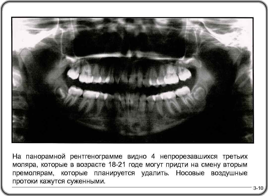На панорамной рентгенограмме видно 4 непрорезавшихся третьих моляра, которые в возрасте 18 -21 годе