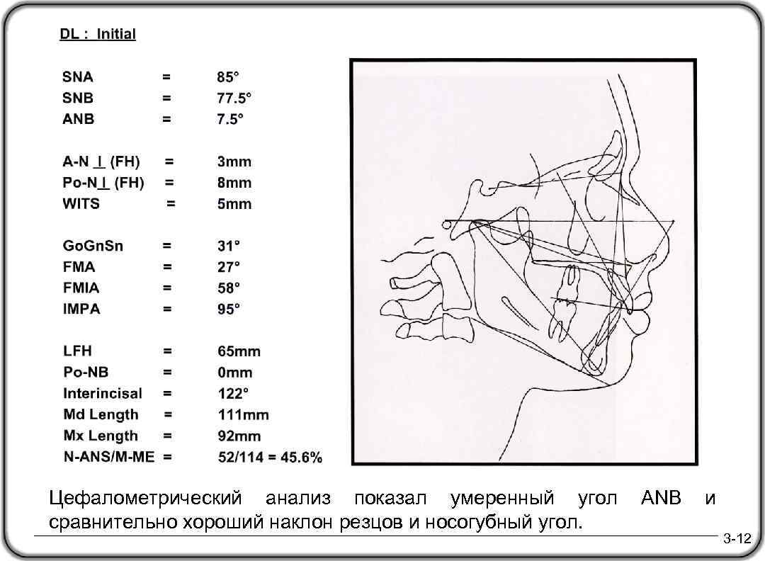 Цефалометрический анализ показал умеренный угол ANB и сравнительно хороший наклон резцов и носогубный угол.