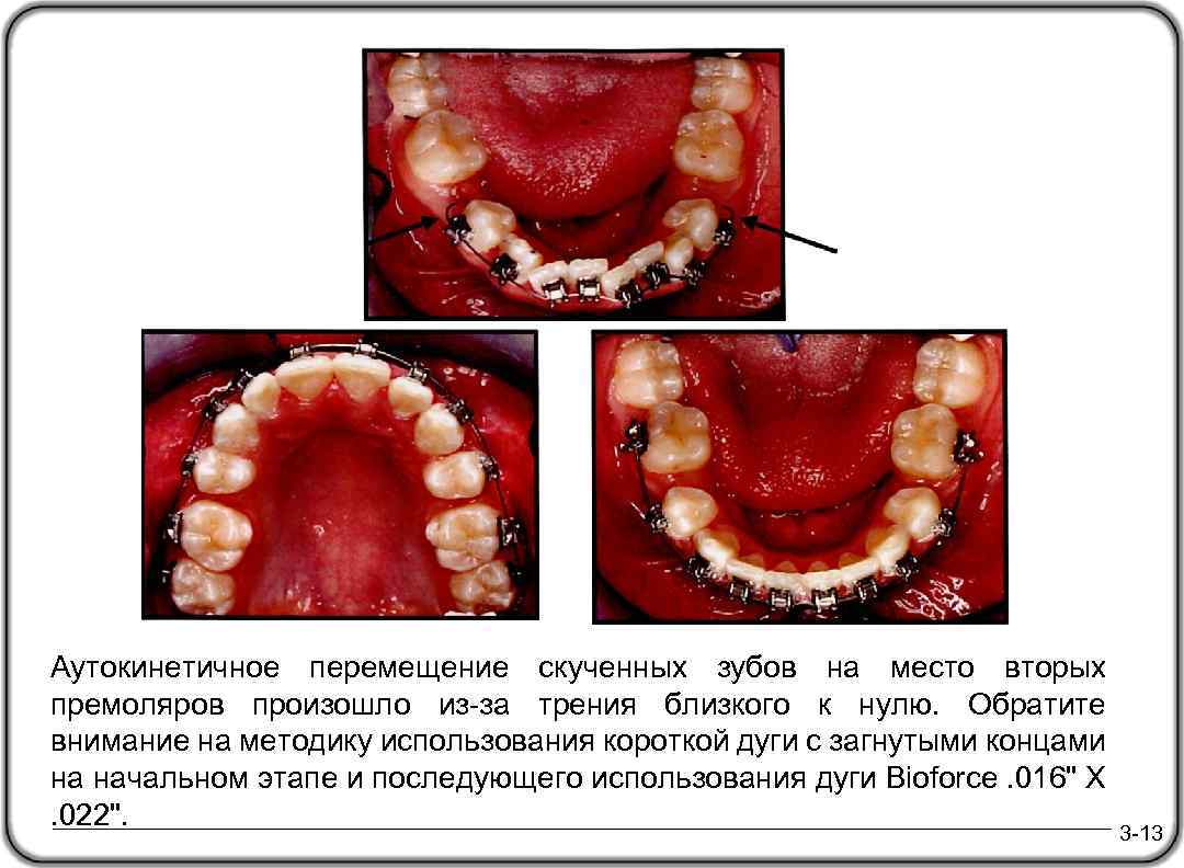 Аутокинетичное перемещение скученных зубов на место вторых премоляров произошло из-за трения близкого к нулю.