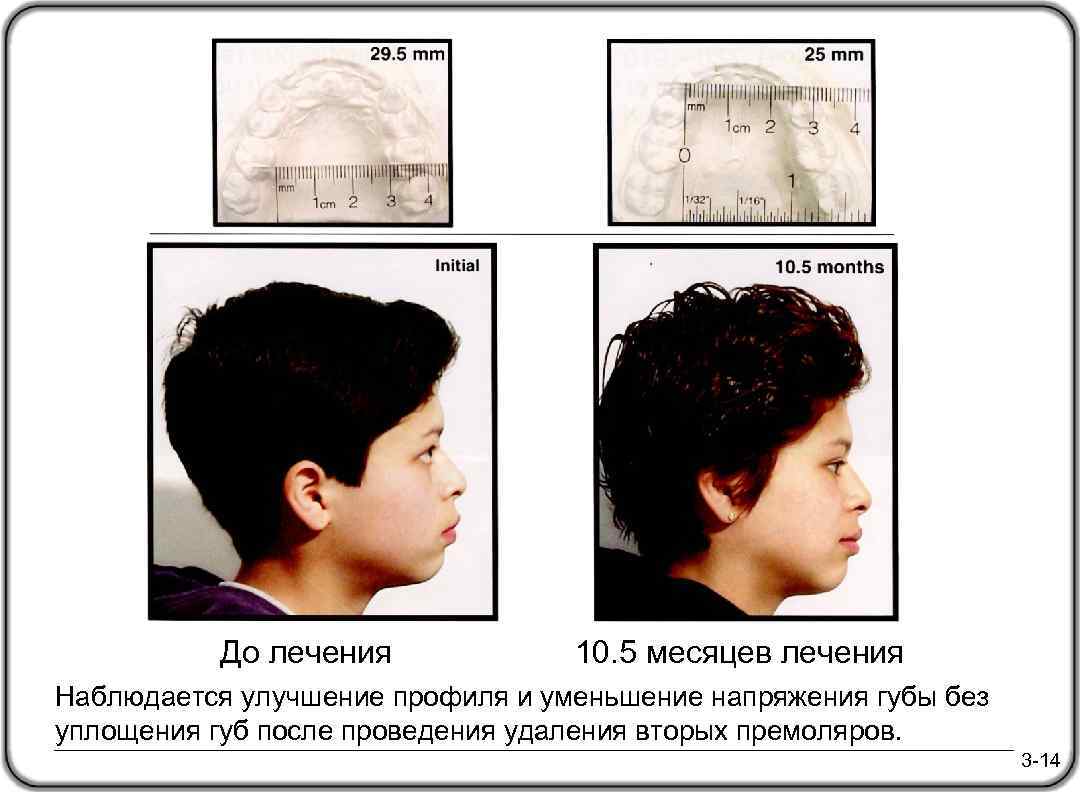 До лечения 10. 5 месяцев лечения Наблюдается улучшение профиля и уменьшение напряжения губы без