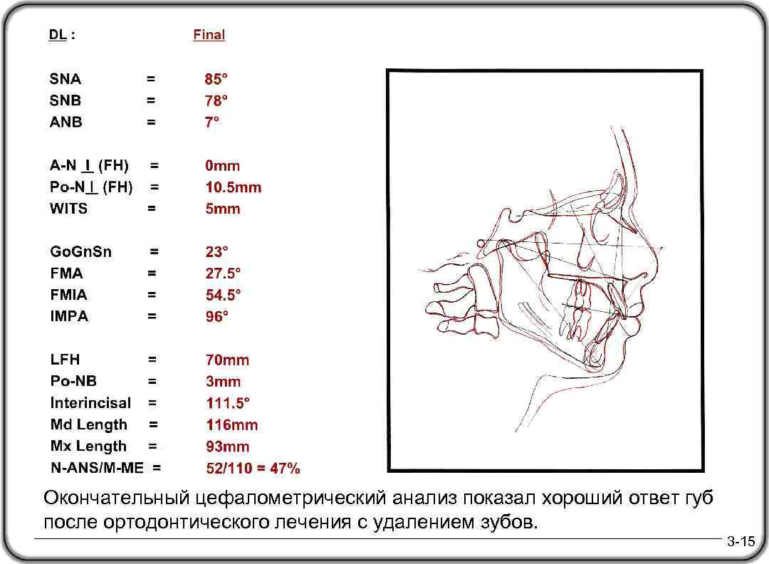 Окончательный цефалометрический анализ показал хороший ответ губ после ортодонтического лечения с удалением зубов. DL,