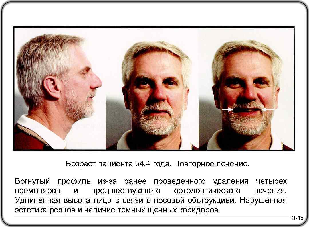 Возраст пациента 54, 4 года. Повторное лечение. Вогнутый профиль из-за ранее проведенного удаления четырех