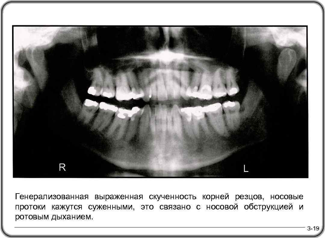 Генерализованная выраженная скученность корней резцов, носовые протоки кажутся суженными, это связано с носовой обструкцией