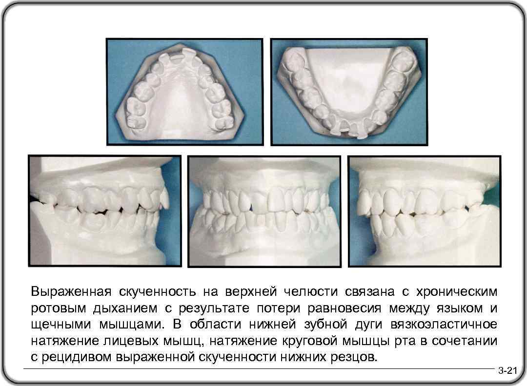 Выраженная скученность на верхней челюсти связана с хроническим ротовым дыханием с результате потери равновесия