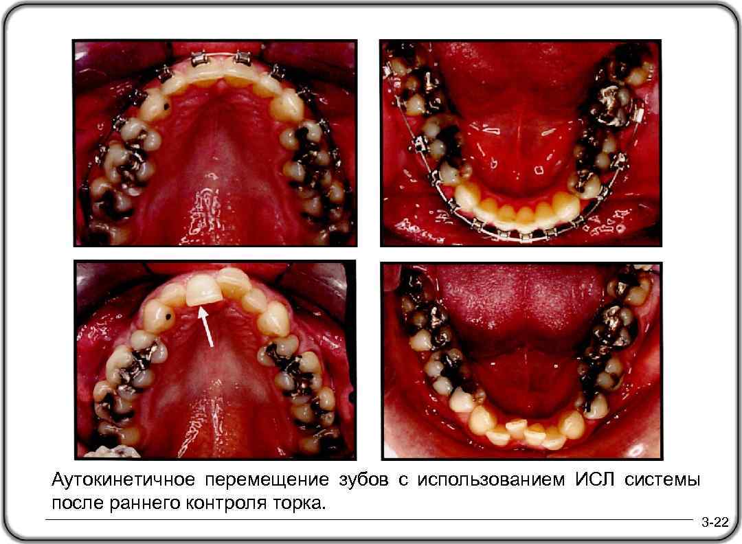 Аутокинетичное перемещение зубов с использованием ИСЛ системы после раннего контроля торка. 3 -22 