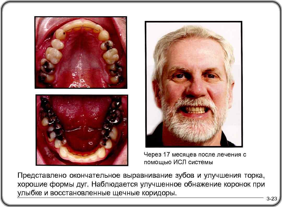 Через 17 месяцев после лечения с помощью ИСЛ системы Представлено окончательное выравнивание зубов и